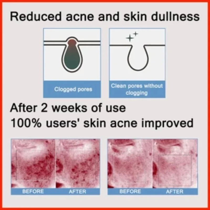 PoreLift Acne Cream