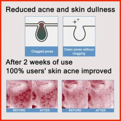 PoreLift Acne Cream
